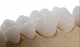 Tìm hiểu về bọc răng sứ Zirconia